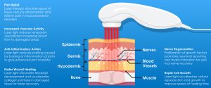 laser physical therapy